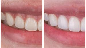 رفع لبخند لثه ایی کد 29