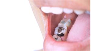 آمالگام دندان کد 02