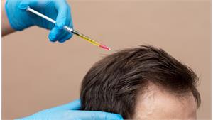 مزوتراپی مو کد 06