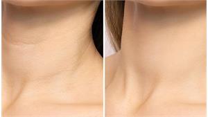 رفع خطوط گردن کد 31