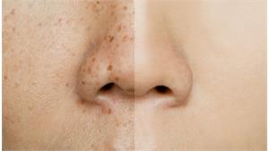 پکیج درمان لک کد 03