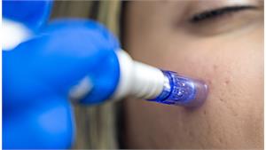 مزونیدلینگ پوست کد 14