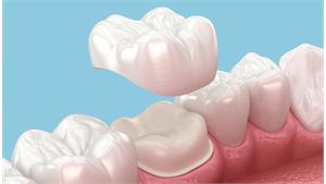 کامپوزیت دندان کد 03