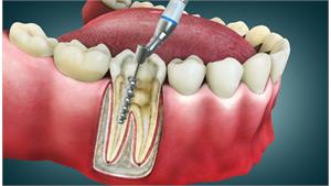 درمان ریشه دندان کد 04