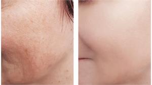 درمان لک های پوستی کد 17