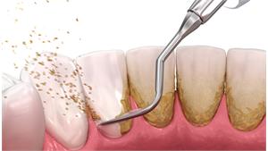 جرم گیری دندان کد 01