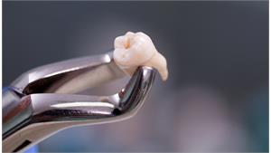 کشیدن دندان (بدون جراحی) کد 06