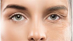 پیش گیری از افتادگی صورت کد 32